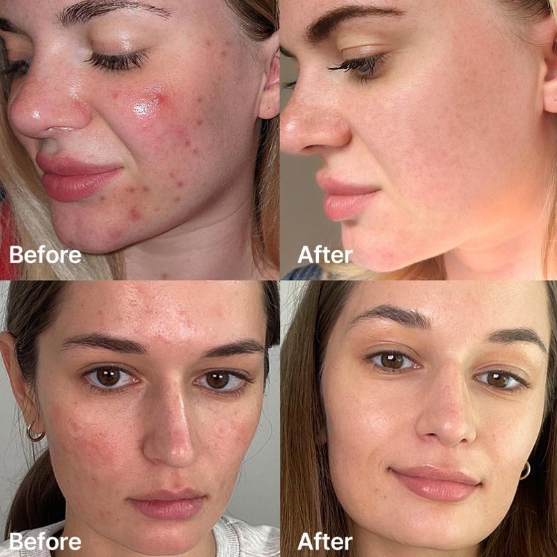 Acne-Free Skin Journey – Purification &amp; Repair Ritual